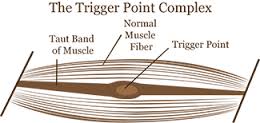 trigger muscle treatment with acupuncture