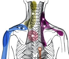 Trigger Points For Neck / Shoulder Pain
