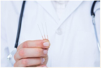 acupuncture for tension headaches