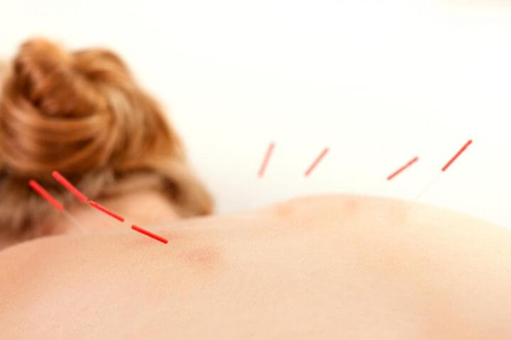acupuncture points on Back