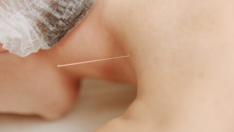 Acupuncture for Neck Injury Treatment