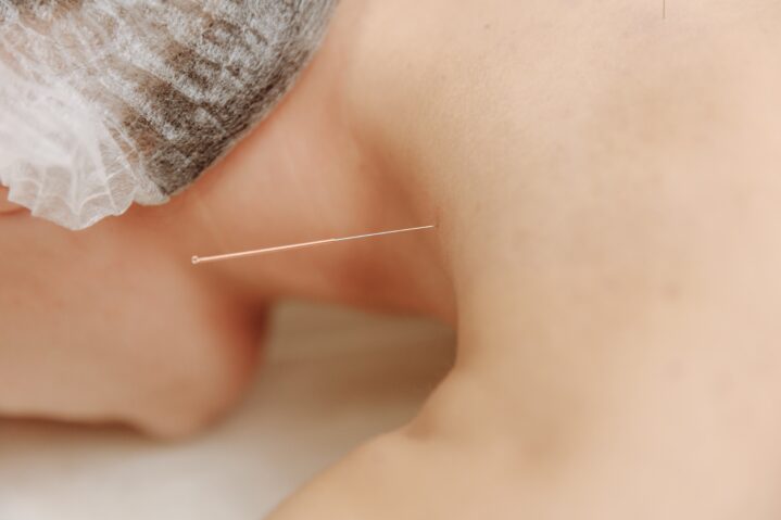 Acupuncture for Neck Injury Treatment